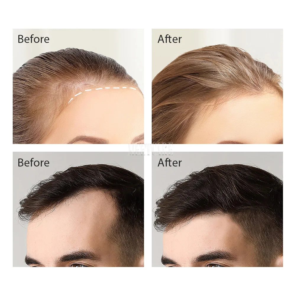 120-Pin Adjustable Microneedle Derma Stamp – For Beard Growth & Skin Renewal